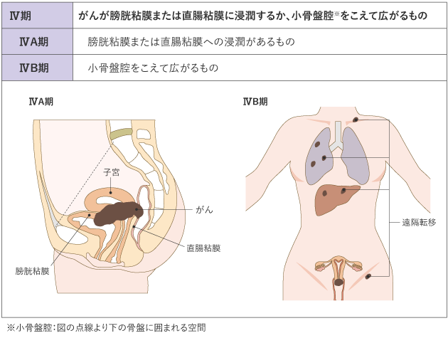 子宮頸がん