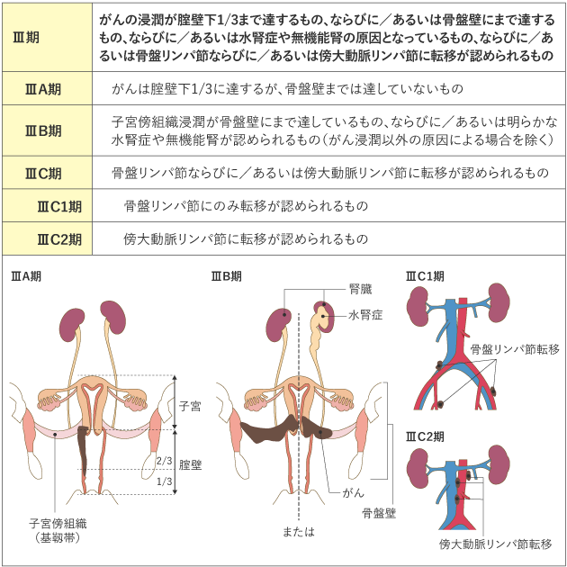 子宮頸がん