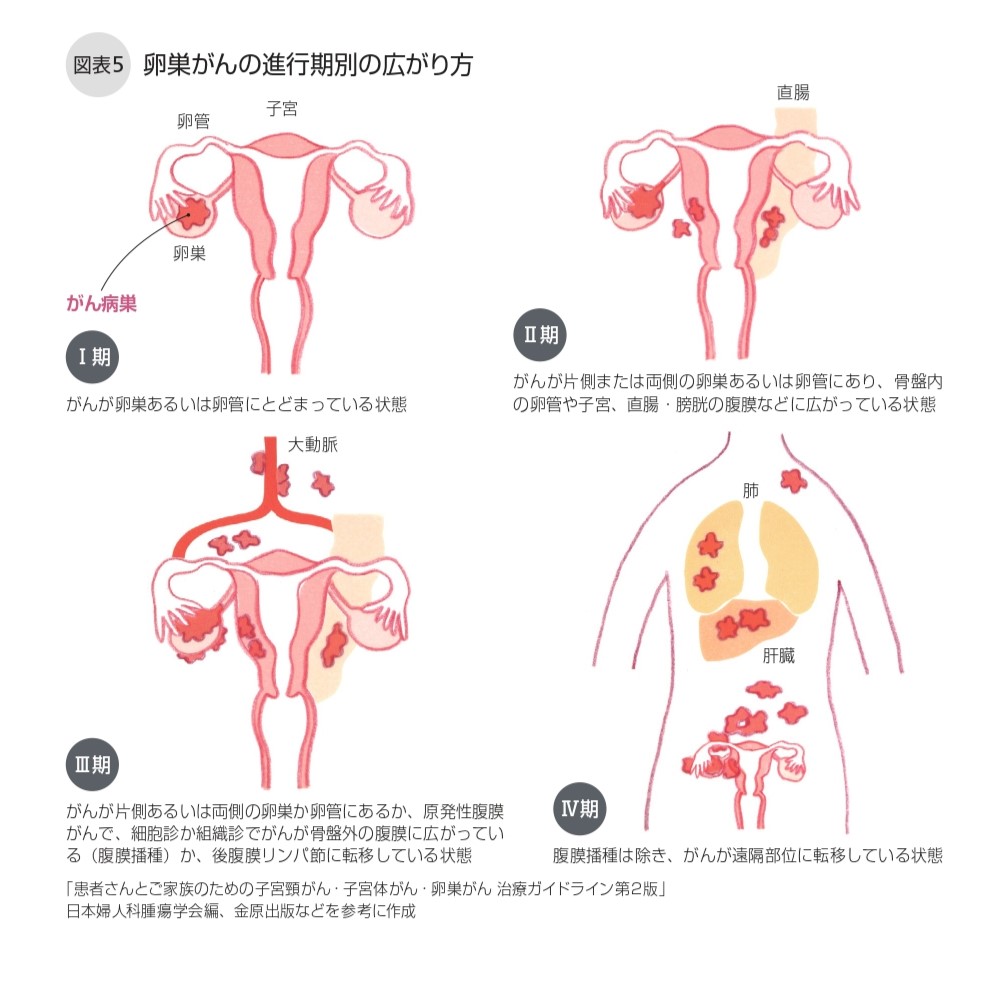 卵巣がん