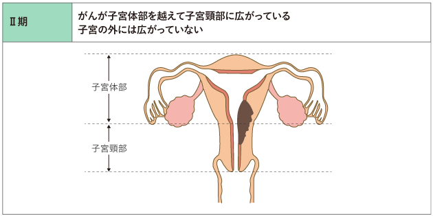 子宮体がん