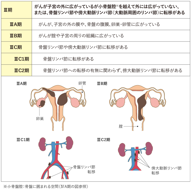 子宮体がん